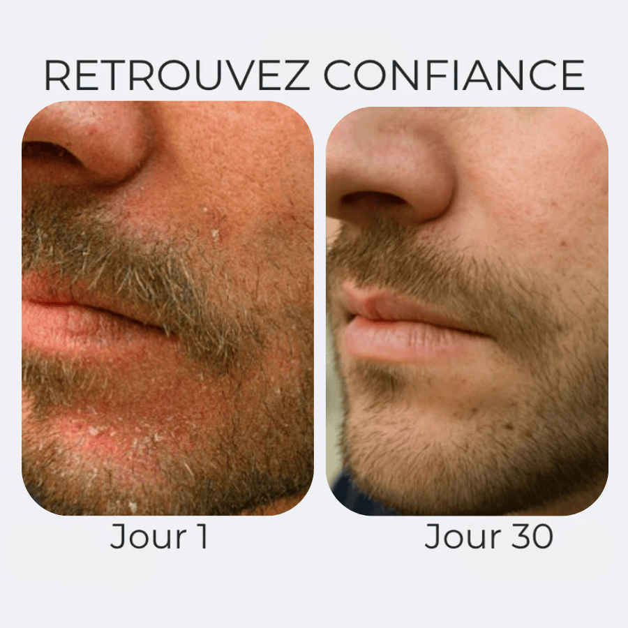 Crème apaisante anti démangeaisons & pellicules