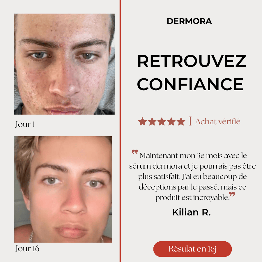Sérum anti-Acné