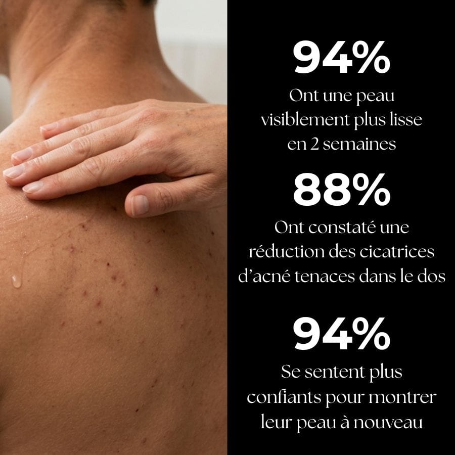 Sérum anti-Acné